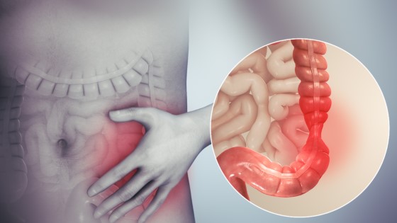 Syndrom dráždivého tračníku dle studií souvisí s kanabinoidní receptory ve střevě. Konkrétně tedy s jejich nedostatkem, čímž dochází k narušení přirozeného prostředí střev